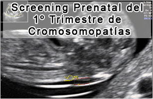 Screening Prenatal del 1 Trimestre de Cromosomopatías